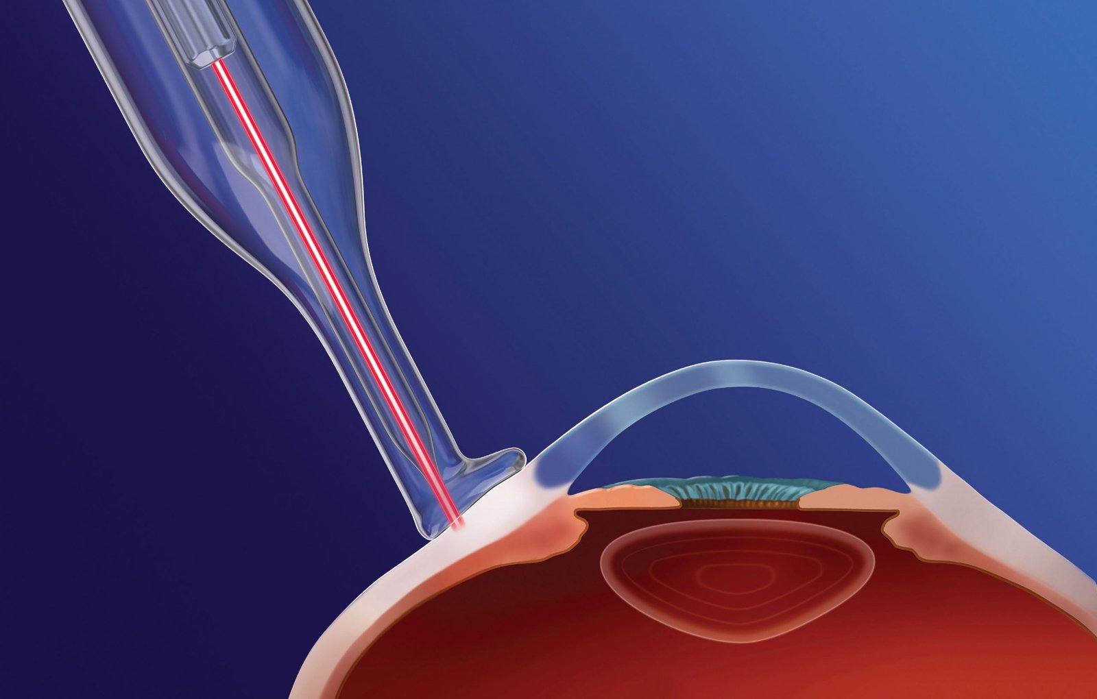 Glaucoma Surgery Shunt Jaipur