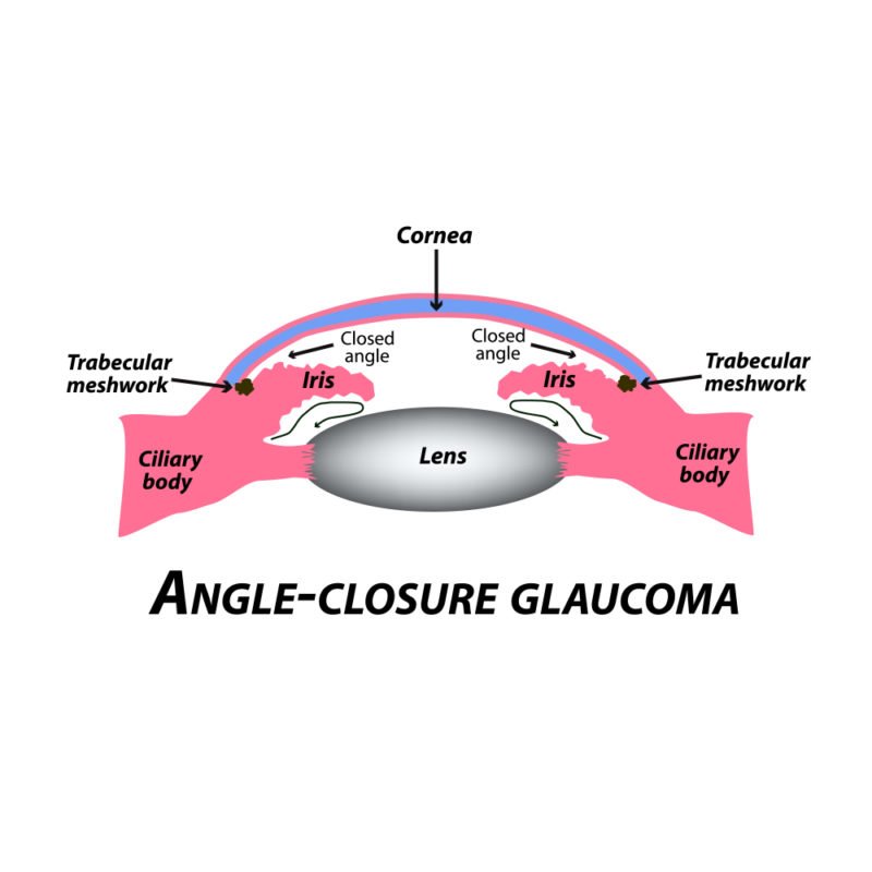 Angle Closure