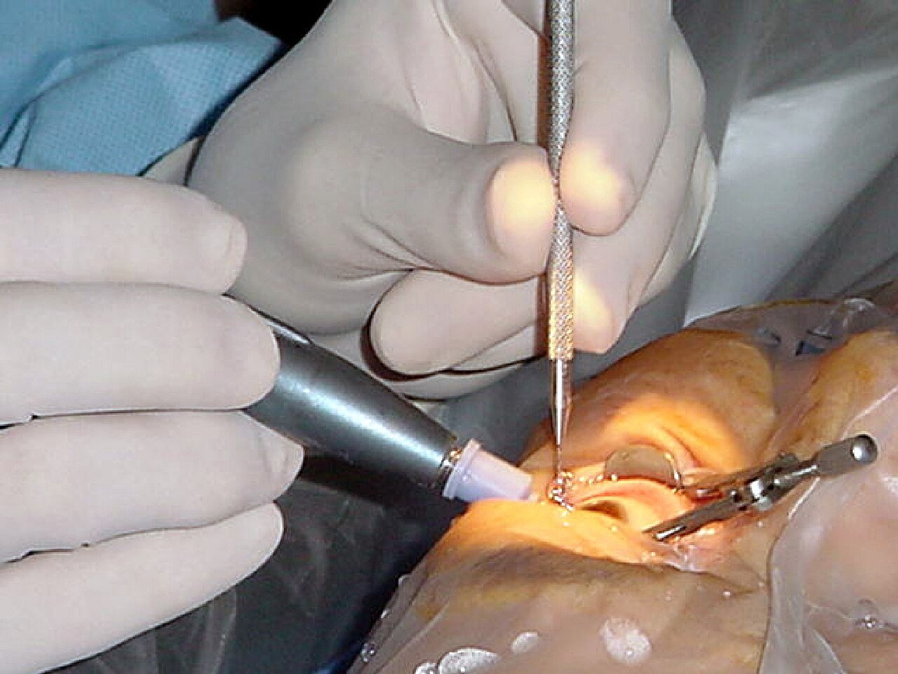 Complex Ocular Surgery