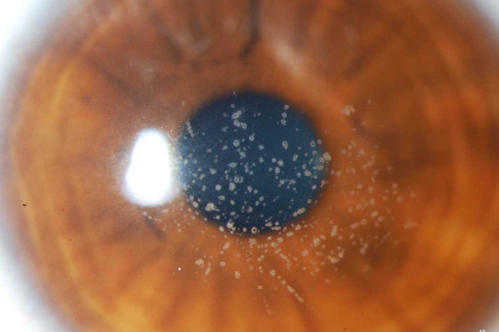 Dystrophy