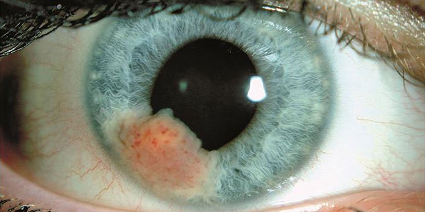 Ocular Oncology Diagnostics
