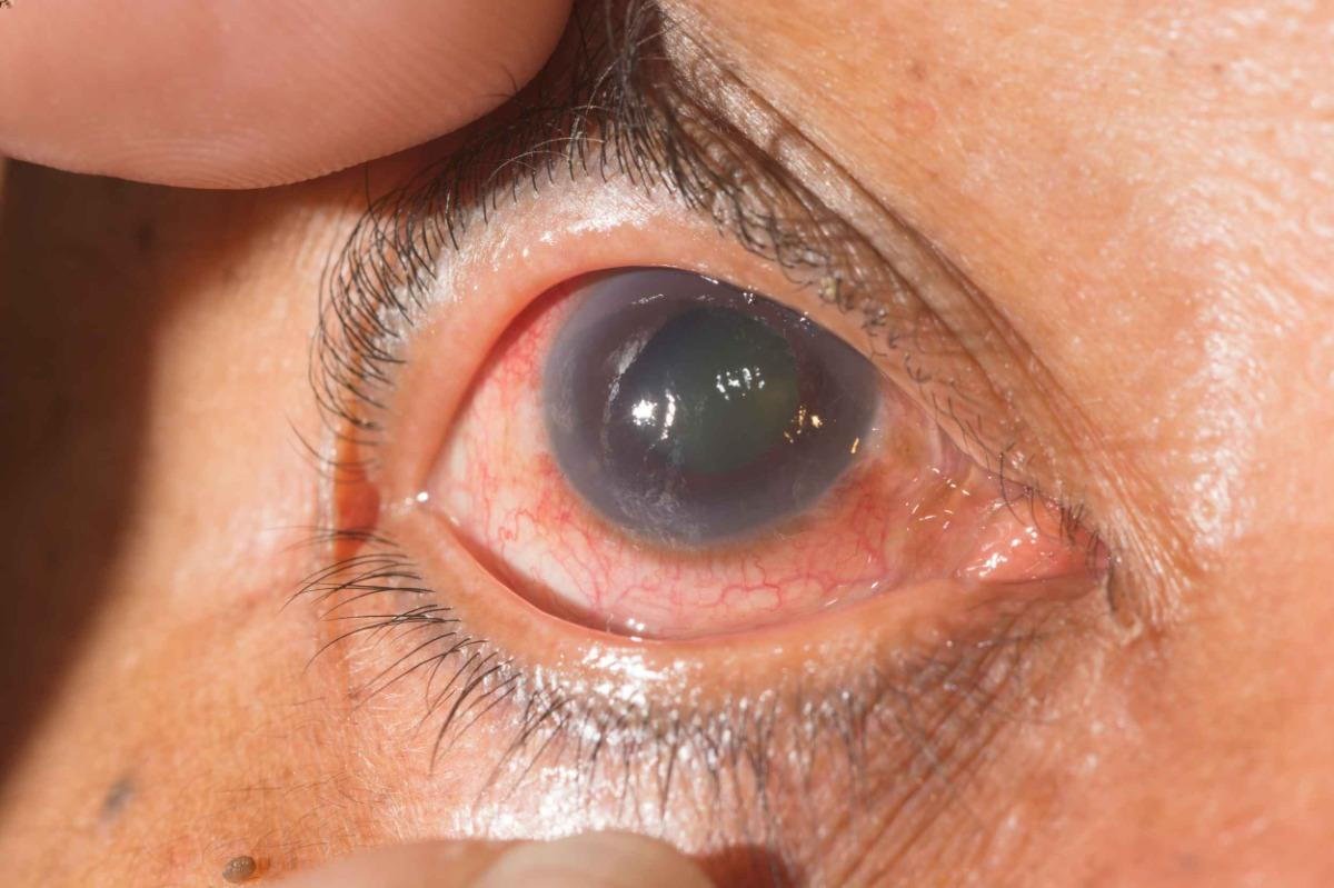 Glaucoma Eye Exam