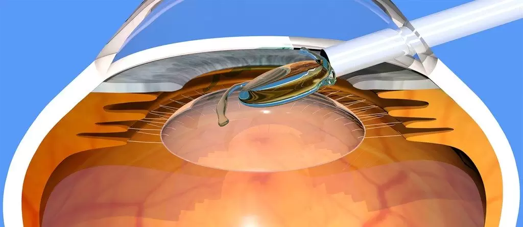ICL Surgery