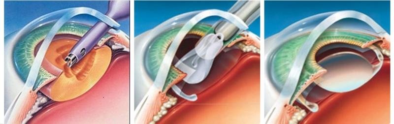 Advanced Cataract Surgery Microscope