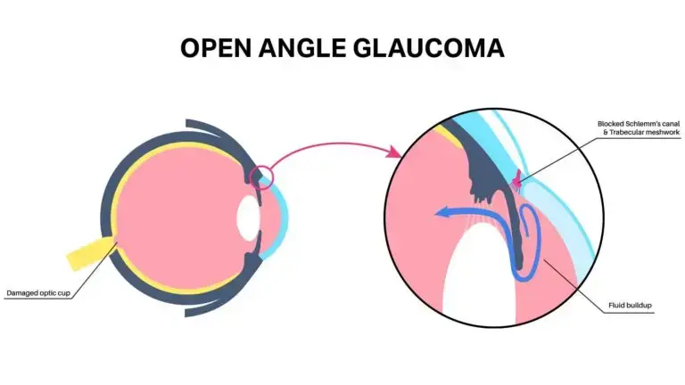 Open Angle