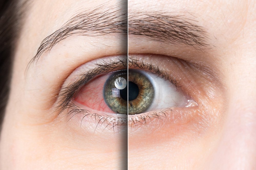 Occlusion