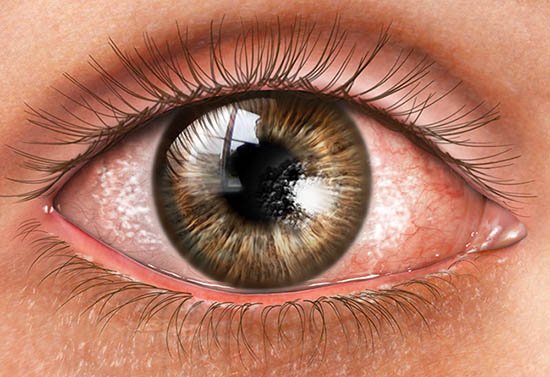 Dry Eye