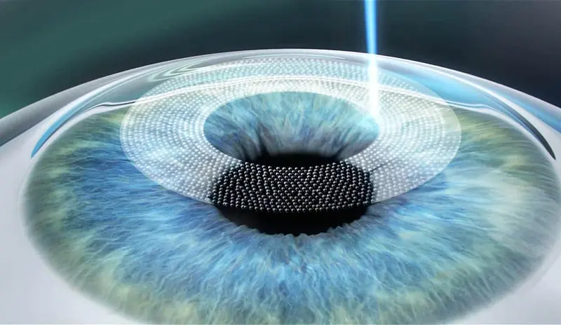 SMILE Pro Flapless LASIK